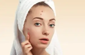 5 Bahan Alami Ampuh Hilangkan Jerawat: Solusi yang Wajib Kamu Coba