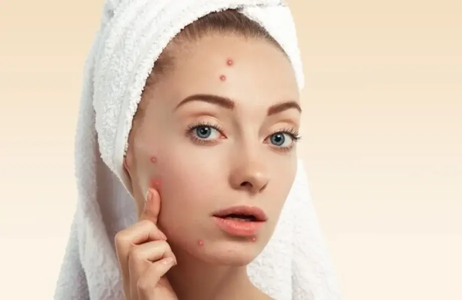 5 Bahan Alami Ampuh Hilangkan Jerawat: Solusi yang Wajib Kamu Coba