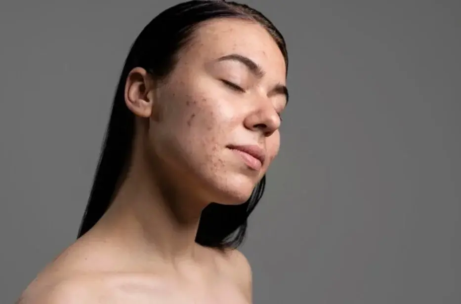 5 Kesalahan Perawatan Kulit yang Membuat Jerawatmu Tak Kunjung Hilang